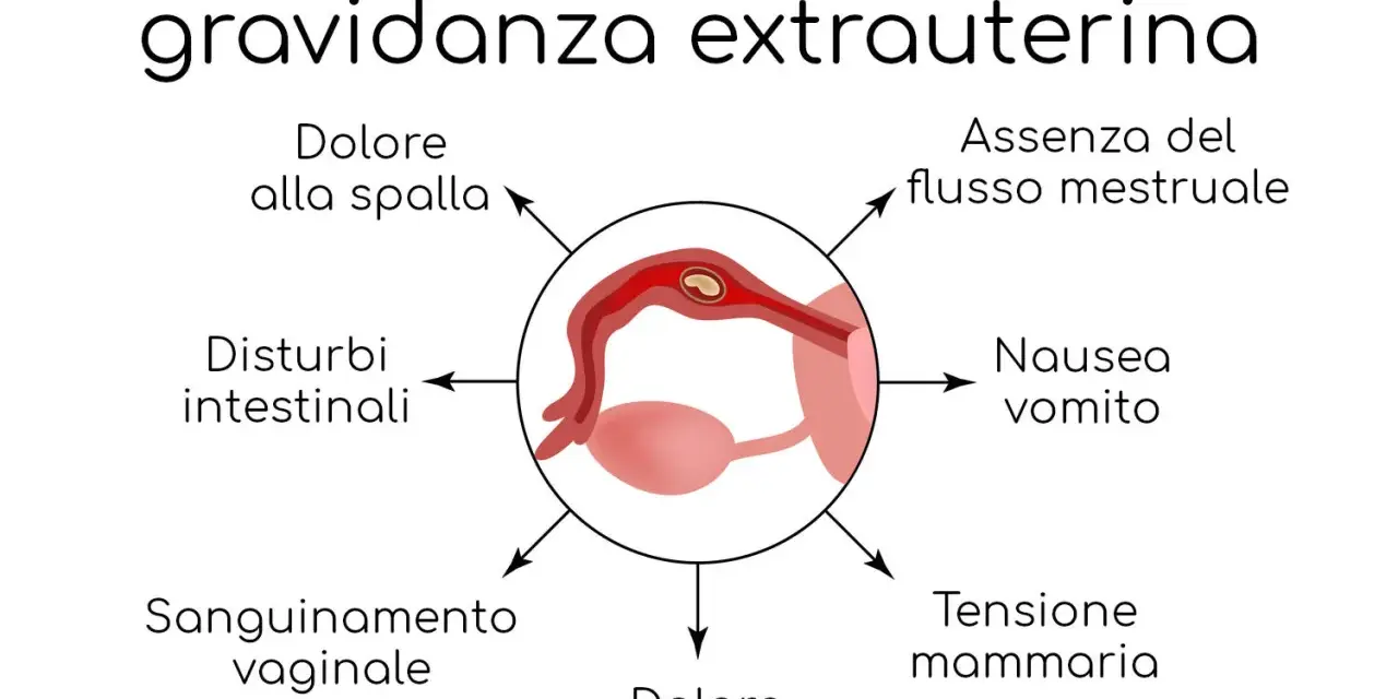 Sintomi di gravidanza extrauterina: dolore spalla, assenza flusso mestruale, nausea, tensione mammaria, dolore pelvico, sanguinamento, disturbi intestinali.