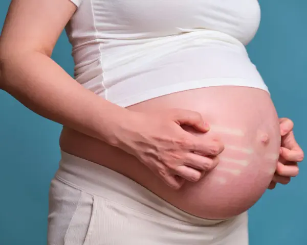 Pancia di donna incinta che si gratta, mostrando segni di prurito in gravidanza.
