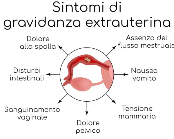 Sintomi di gravidanza extrauterina: dolore spalla, assenza flusso mestruale, nausea, tensione mammaria, dolore pelvico, sanguinamento, disturbi intestinali.