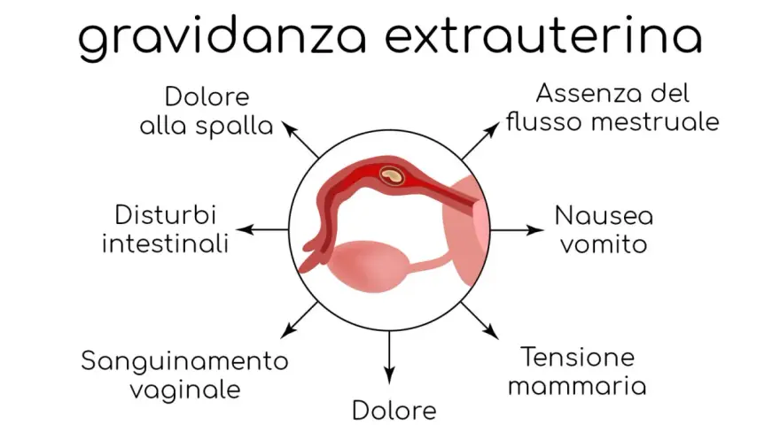 Sintomi di gravidanza extrauterina: dolore spalla, assenza flusso mestruale, nausea, tensione mammaria, dolore pelvico, sanguinamento, disturbi intestinali.