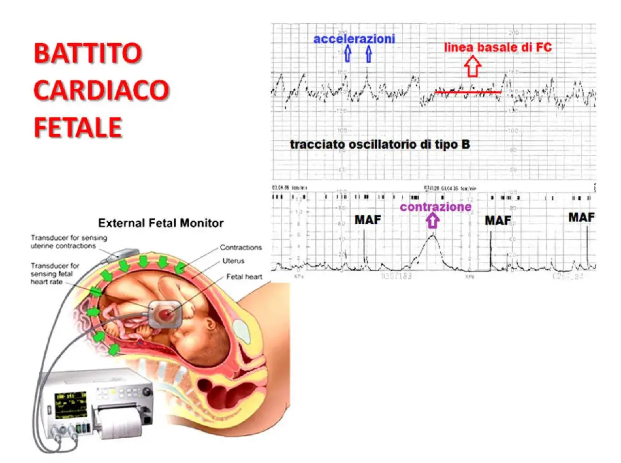 Monitoraggio del battito cardiaco fetale con grafici che mostrano accelerazioni, contrazioni e tracciato oscillatorio.