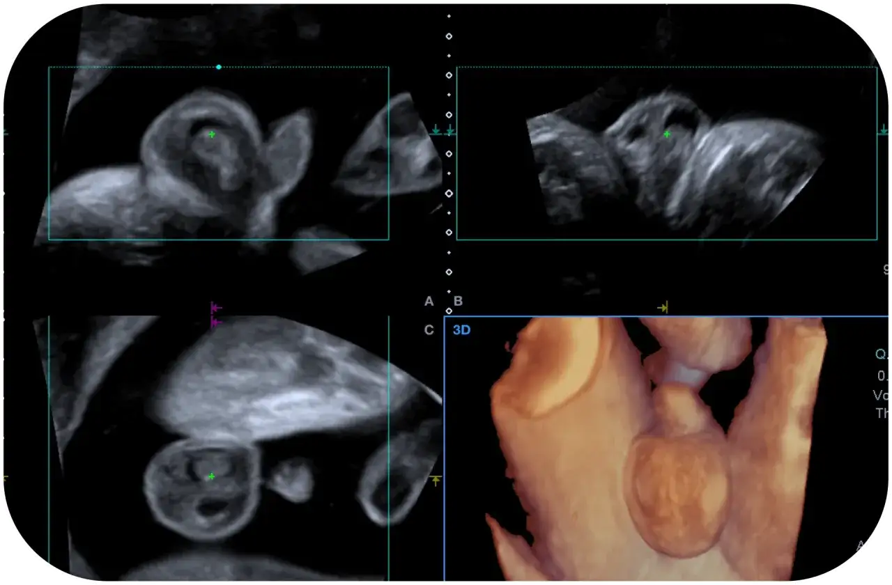 Ecografia 3D mostra il feto nel secondo trimestre gravidanza, con dettagli del viso e del corpo.
